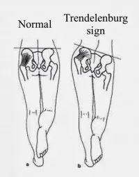 https://www.physio-pedia.com/Anatomy_Slings_and_Their_Relationship_to_Low_Back_Pain